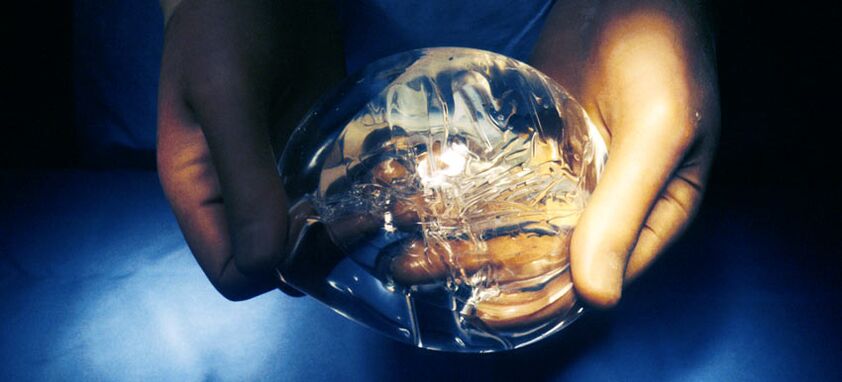 Silikonska endoproteza